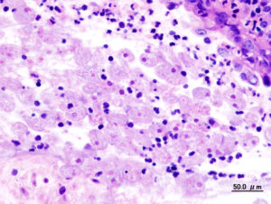 Amoebic dysentery 