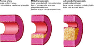 Arteriosclerosis