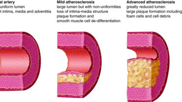 Arteriosclerosis