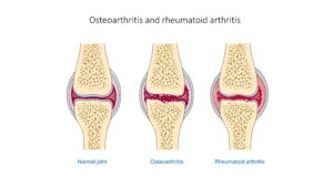 Arthritis