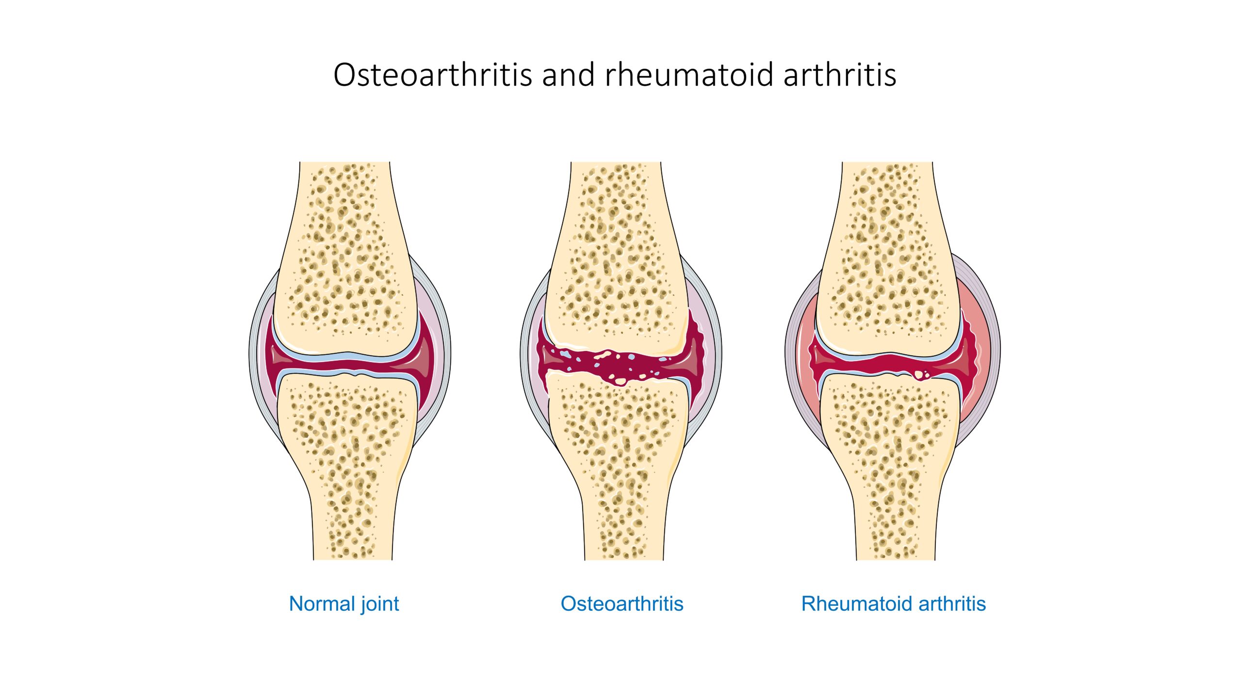 Arthritis